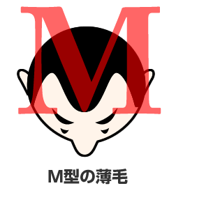 M型の薄毛イメージ